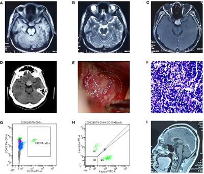 Sellar B lymphoblastic lymphoma mimics pituitary apoplexy with newly discovered gene mutations in TP53 and PAX5: A case report